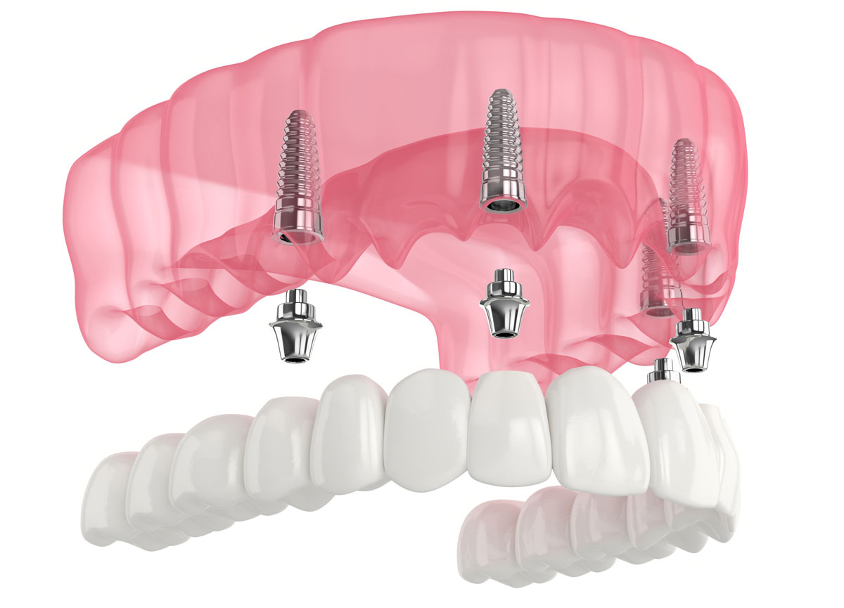 all-on-4-implant